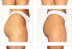 Endermologia, zdjęcia przed i po zabiegu